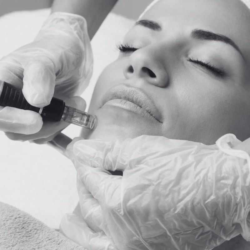 Microneedling