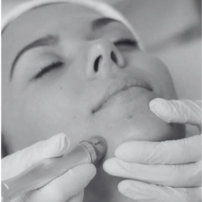 Hydro-Dermabrasion Facial