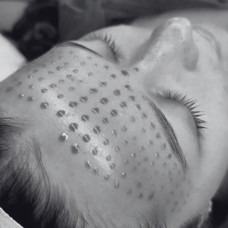 BioRePeel Chemical Peel