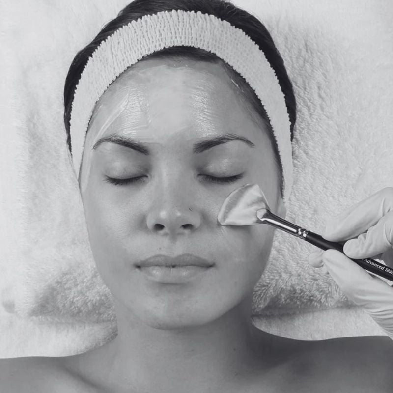 Chemical Peel