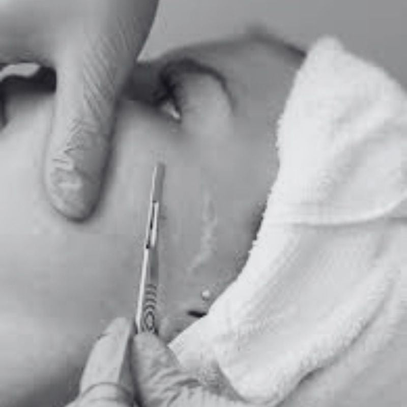 dermaplaning