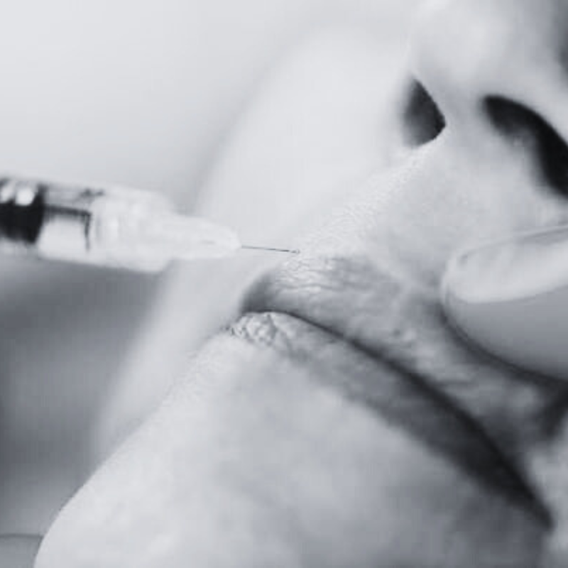perioral (smokers) lines filler
