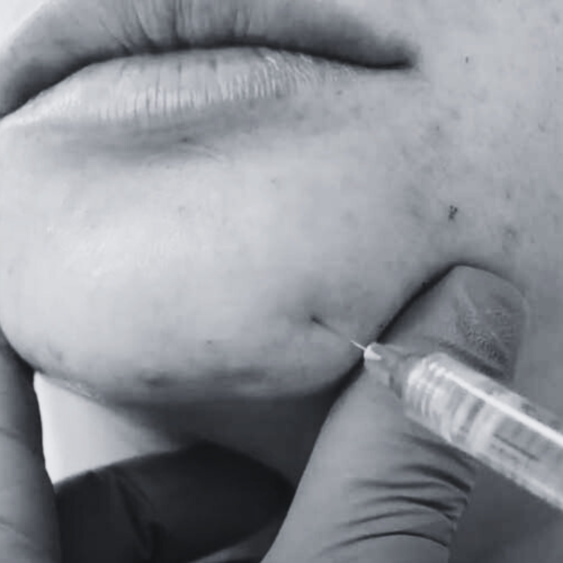 chin filler