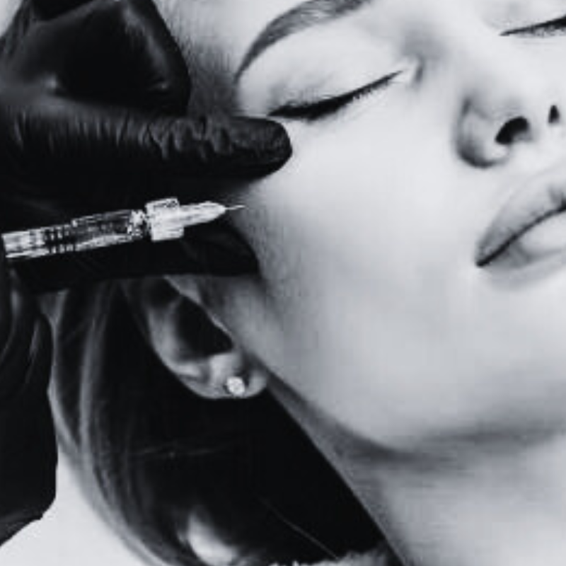 cheek filler