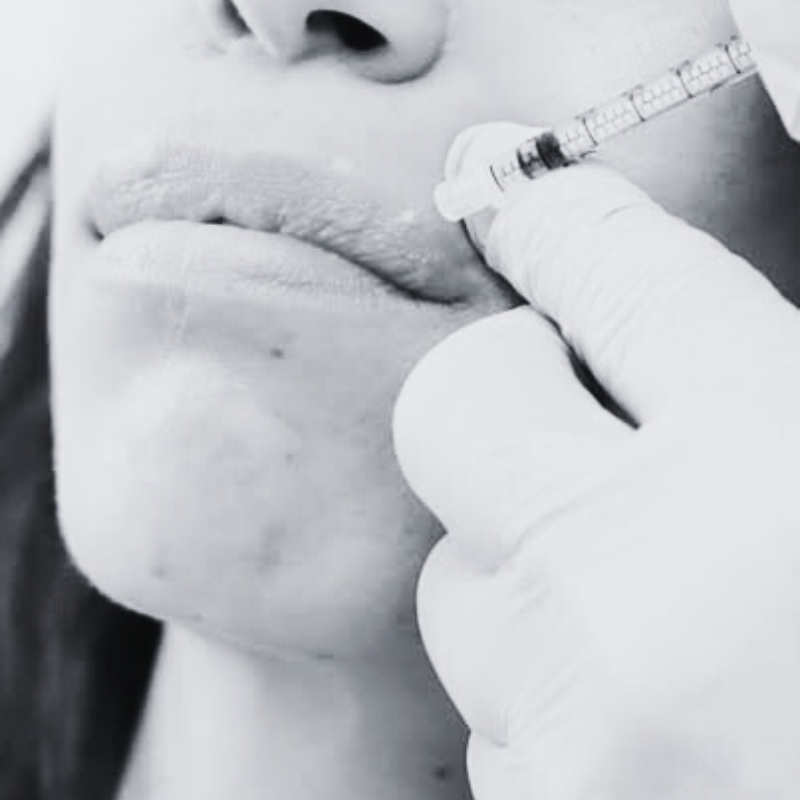 lip flip