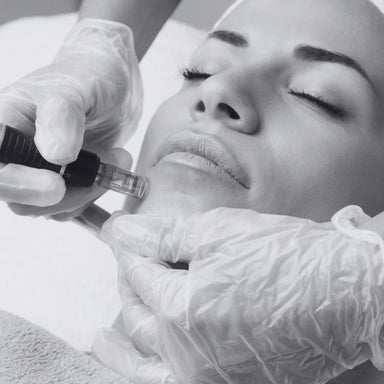 wolverhampton microneedling